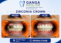 Braces and aligners