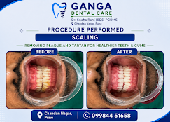 Teeth whitening